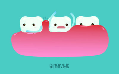 Why You Should Look Out For Gingivitis
