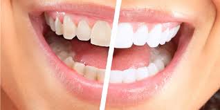 Teeth Whitening: 5 things you should know