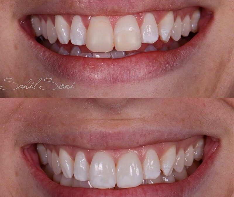 Feel Confident in 2023 With Whiter Teeth