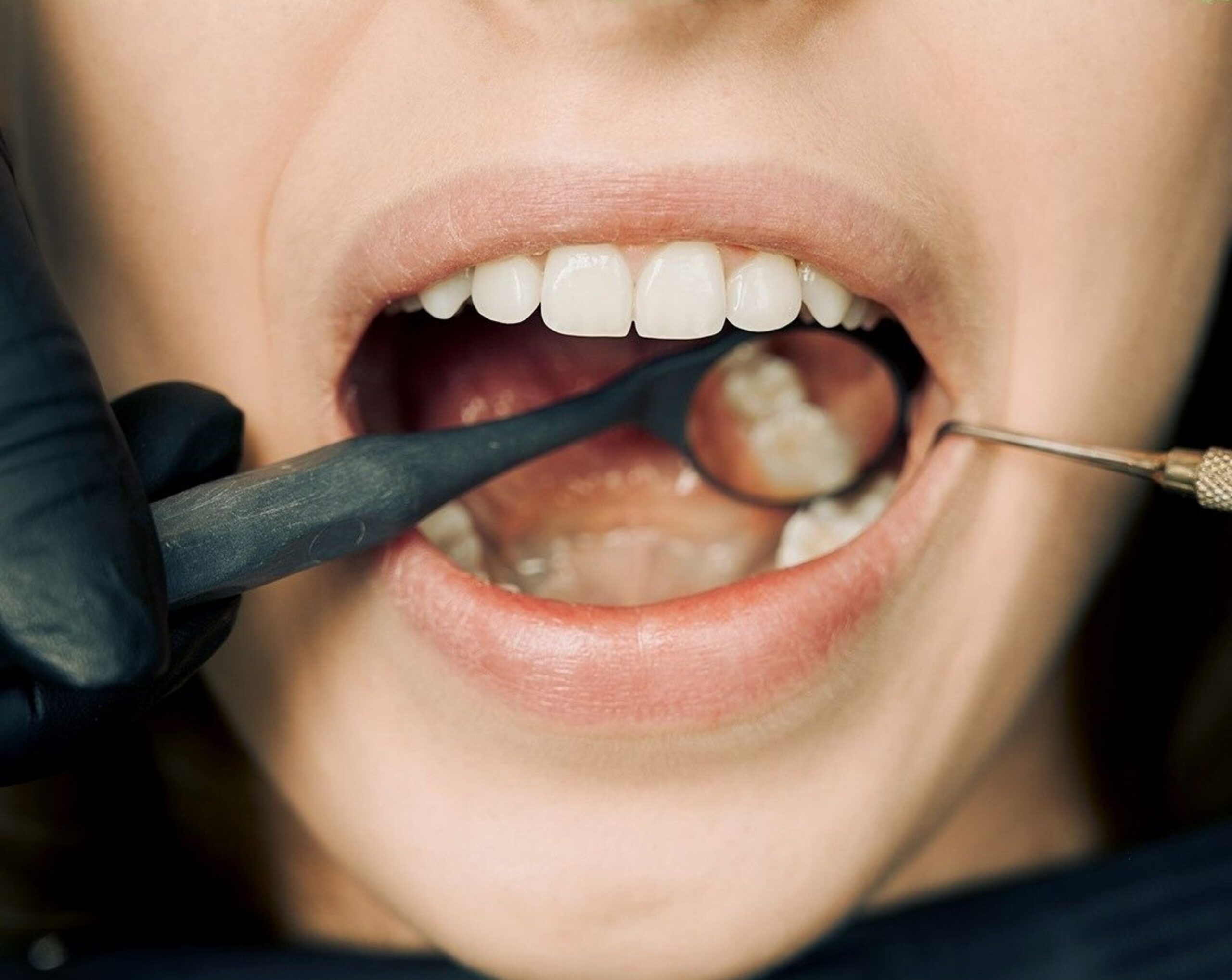 dental cavities and fillings