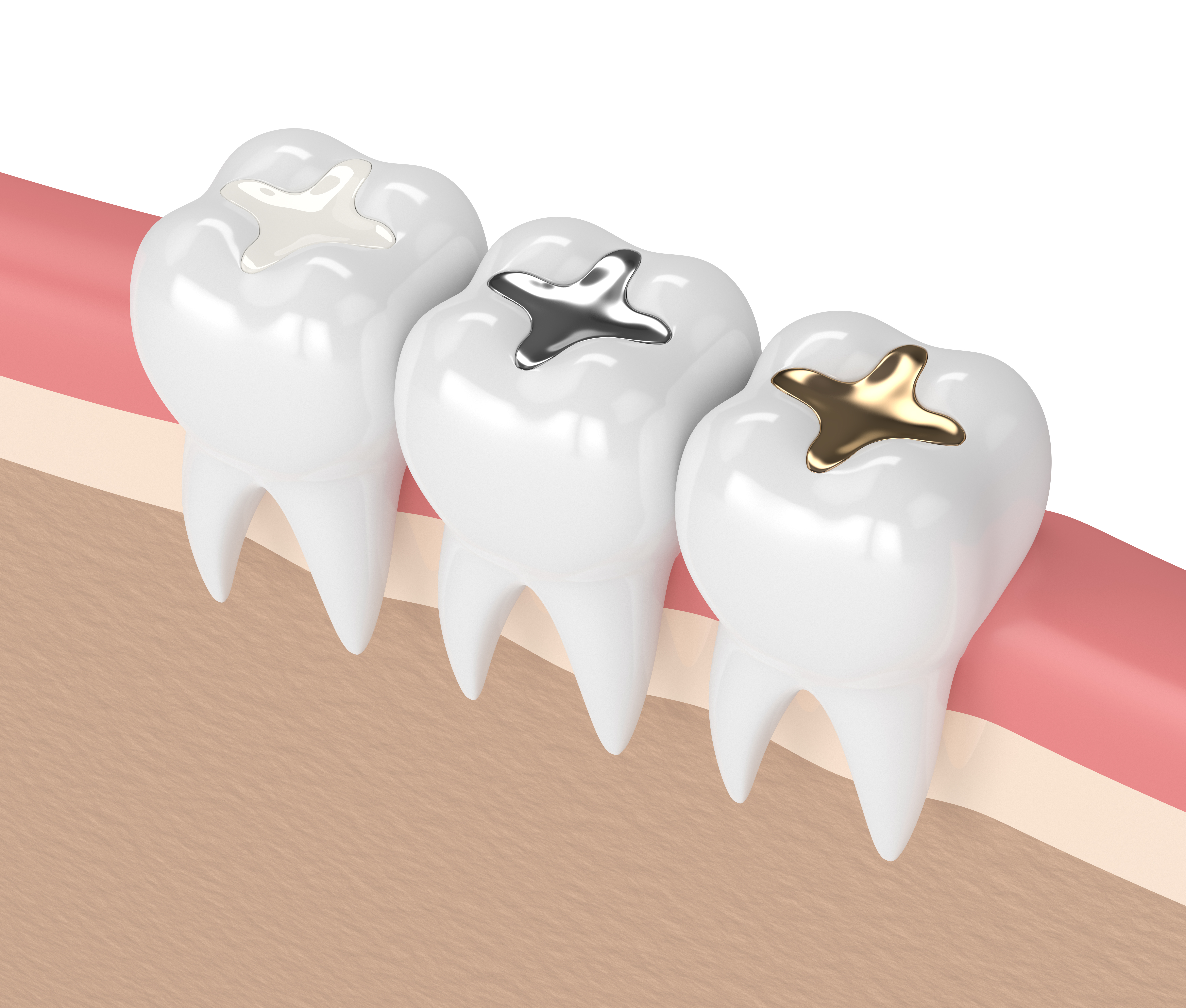 Understanding dental fillings