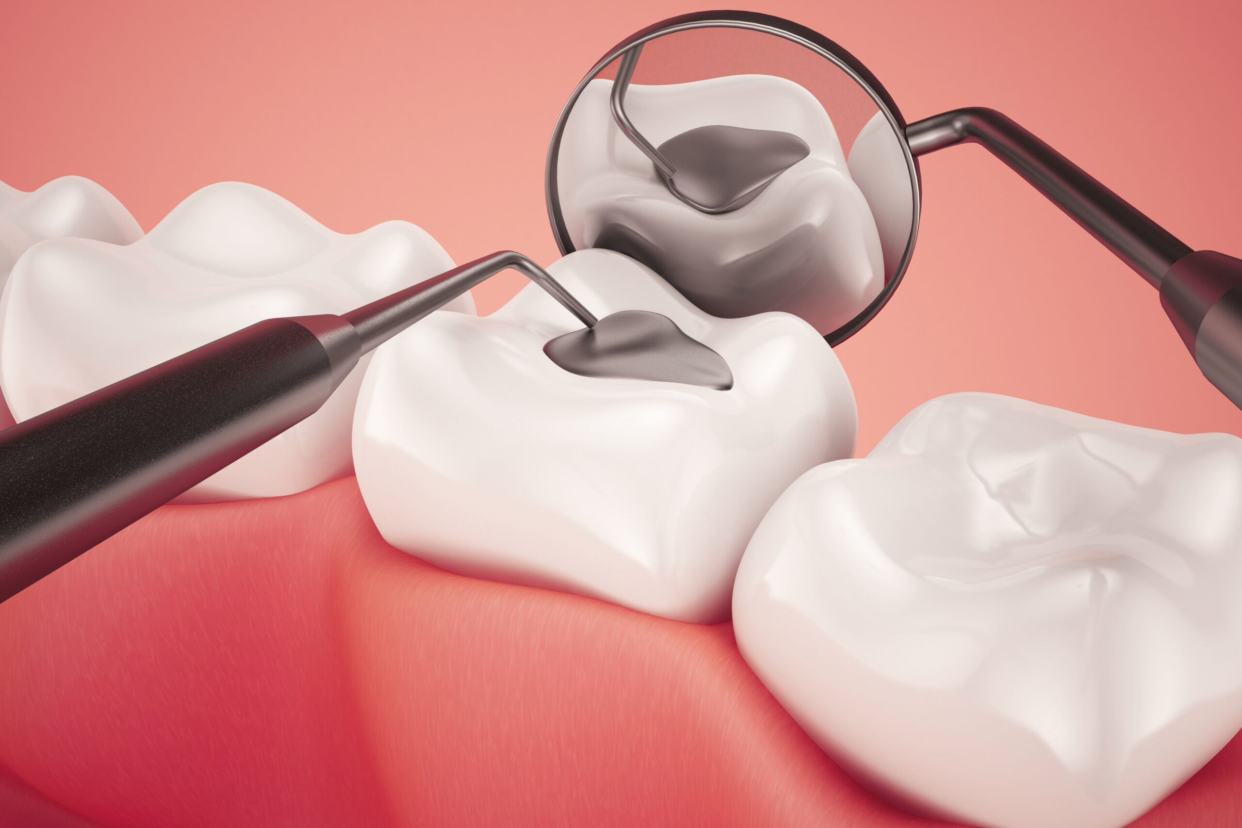 what to expect in a dental filling procedure