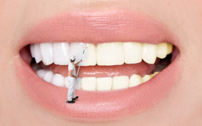 Choosing Between Dental Veneers and Teeth Whitening
