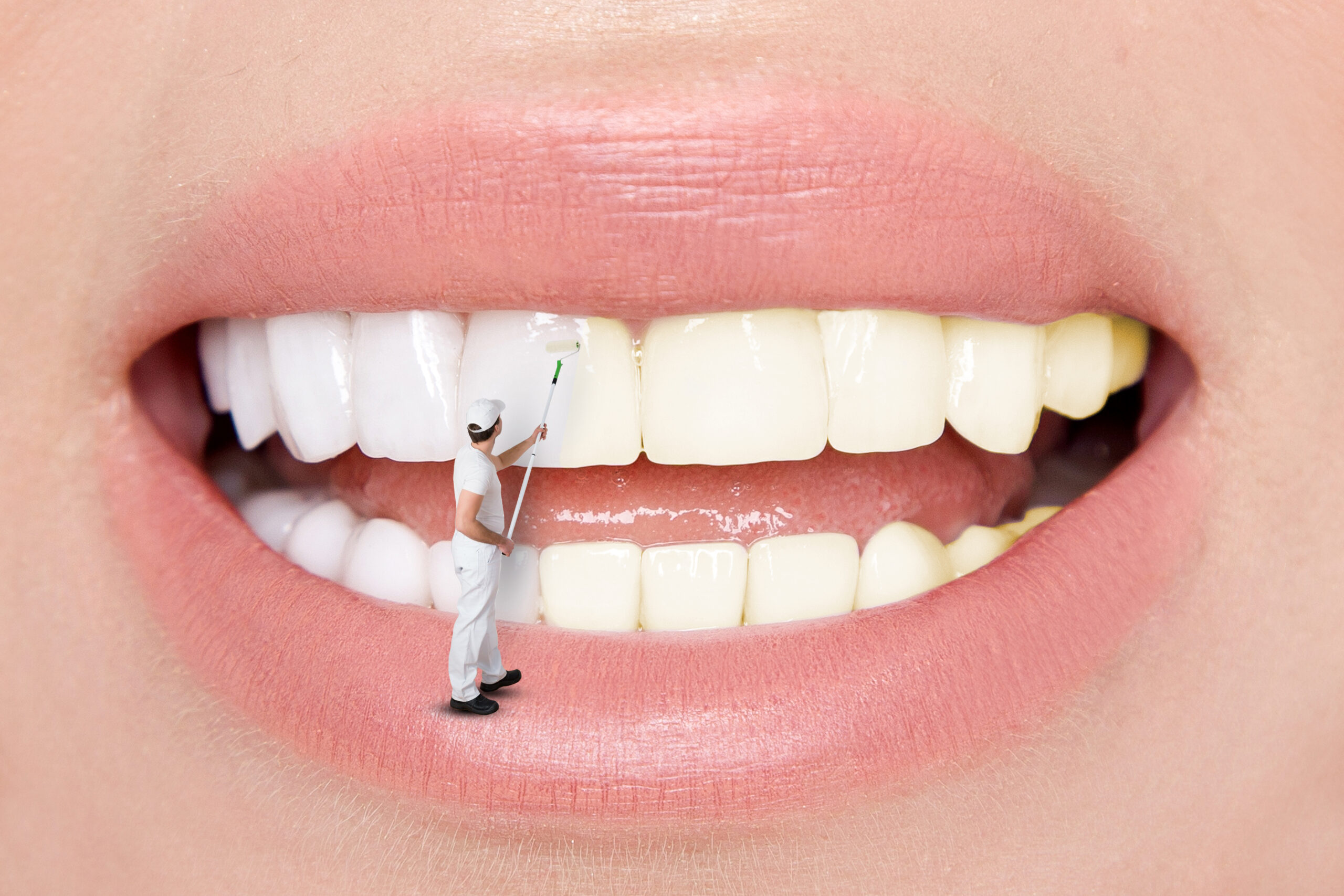 dental veneers and teeth whitening